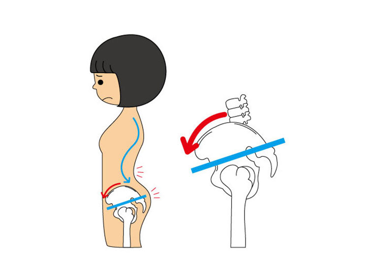 骨盤前傾の絵