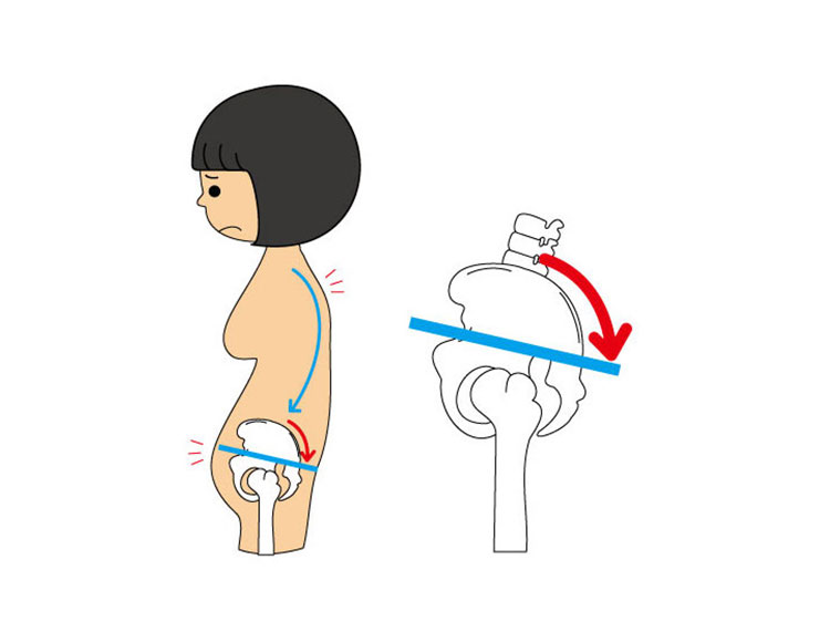 骨盤後傾の絵